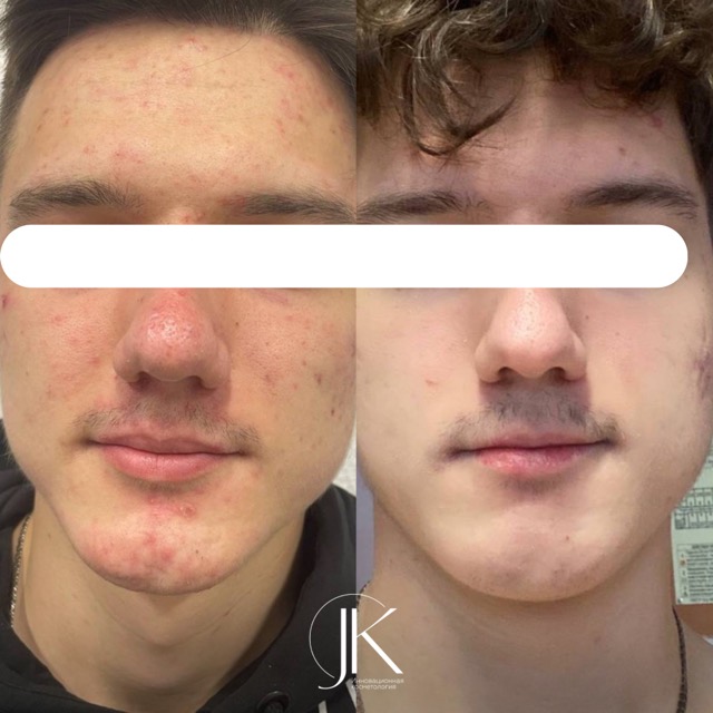 JK Clinic - до и после, процедура, Туран Закировна Буладжова