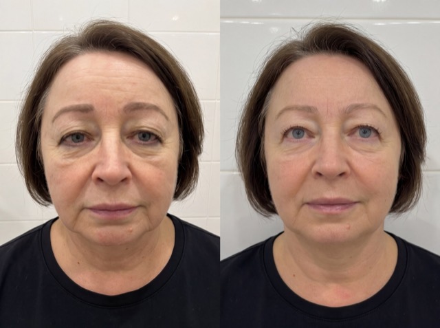 JK Clinic - до и после, сочетанные методики, Дина Римовна Глебова