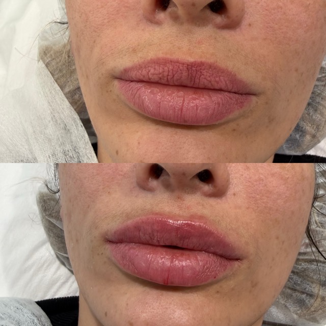 JK Clinic - до и после, контурная пластика, Дина Римовна Глебова