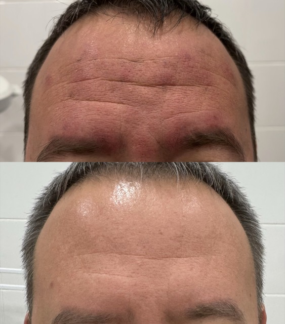 JK Clinic - до и после, ботулинотерапия, Дина Римовна Глебова