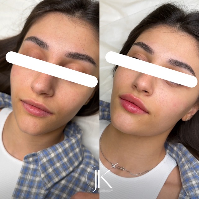 JK Clinic - до и после, Контурная пластика, Афродита Витальевна Исагулова