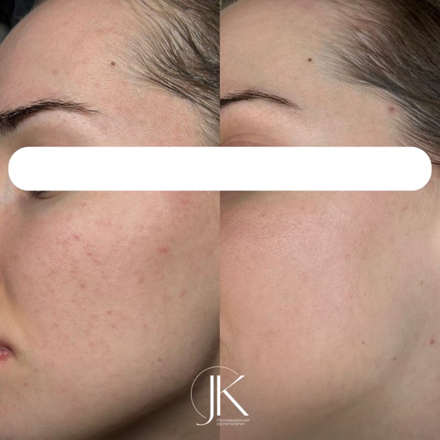 JK Clinic - до и после, процедура, Афродита Витальевна Исагулова