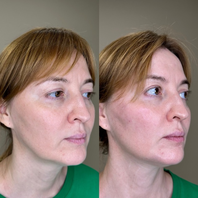 JK Clinic - до и после, Радиес, Афродита Витальевна Исагулова