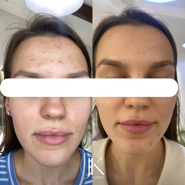 JK Clinic - до и после, Хелео, Юлия Алексеевна Карагаева
