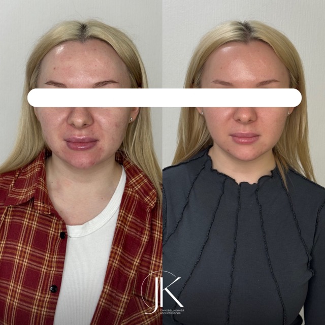 JK Clinic - до и после, Биоревитализация, Юлия Алексеевна Карагаева