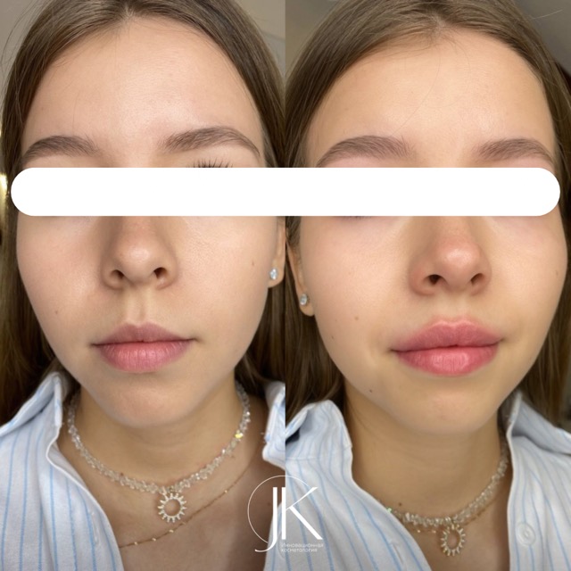 JK Clinic - до и после, Контурная пластика губы, Юлия Алексеевна Карагаева