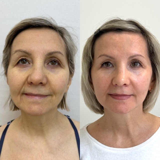 JK Clinic - до и после, процедура, Екатерина Евгеньевна Кашина
