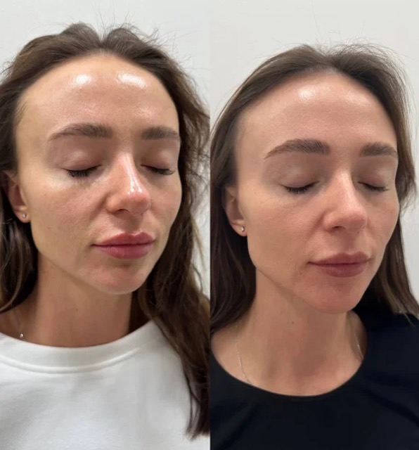 JK Clinic - до и после, процедура, Екатерина Евгеньевна Кашина