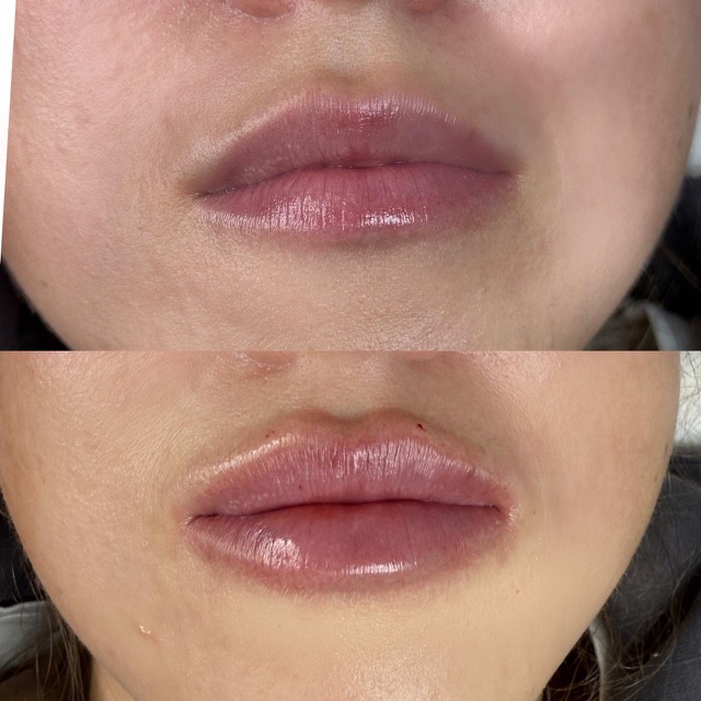 JK Clinic - до и после, процедура, Наталья Васильевна Коваленко