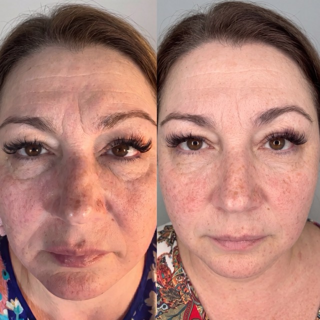 JK Clinic - до и после, контурная пластика, Марина Владимировна Крапивина