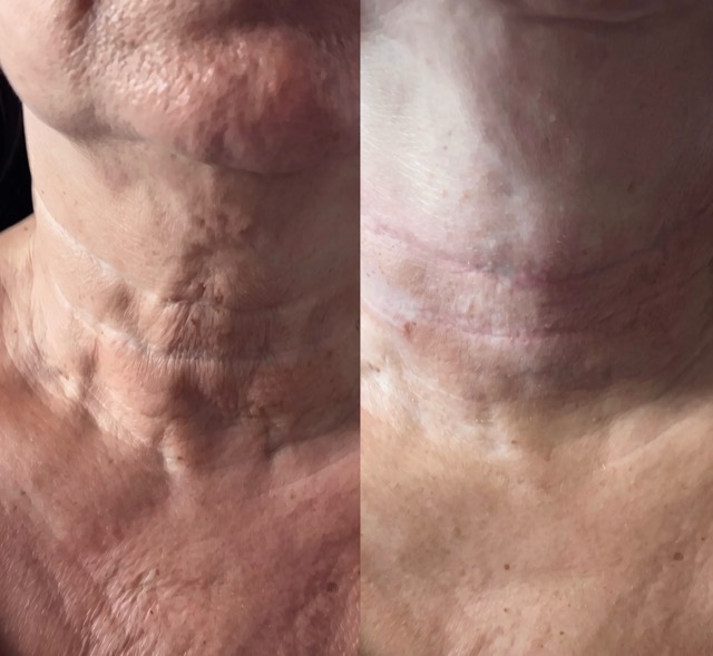 JK Clinic - до и после, биоревитализация, Марина Владимировна Крапивина