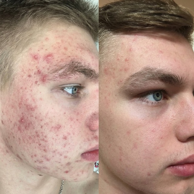 JK Clinic - до и после, лечение акне, Марина Владимировна Крапивина