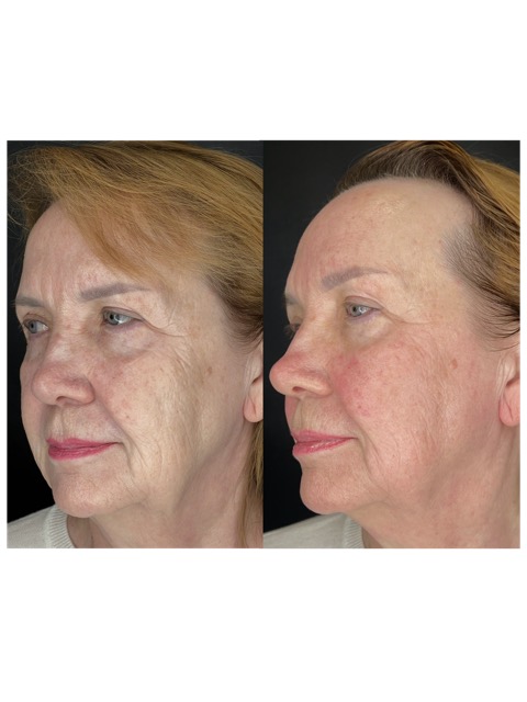 JK Clinic - до и после, сочетанные методики, Александра Сергеевна Крашенинникова