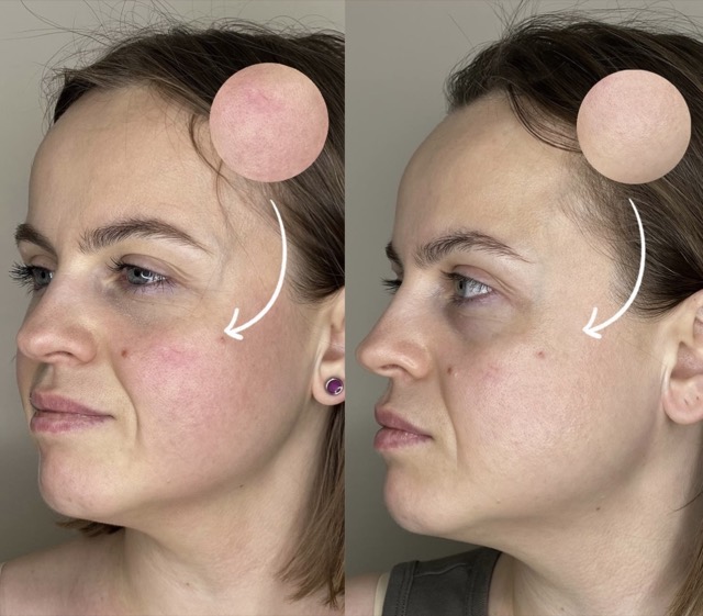 JK Clinic - до и после, Dermadrop, Александра Сергеевна Крашенинникова