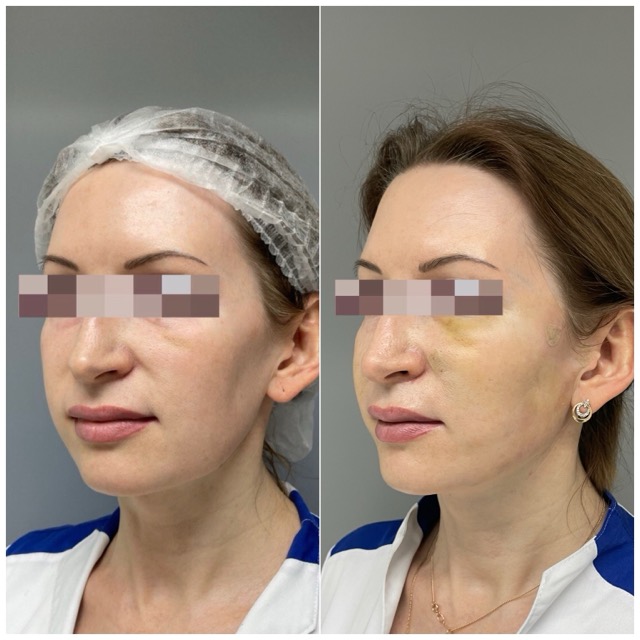 JK Clinic - до и после, процедура, Евгения Викторовна Проскурнина