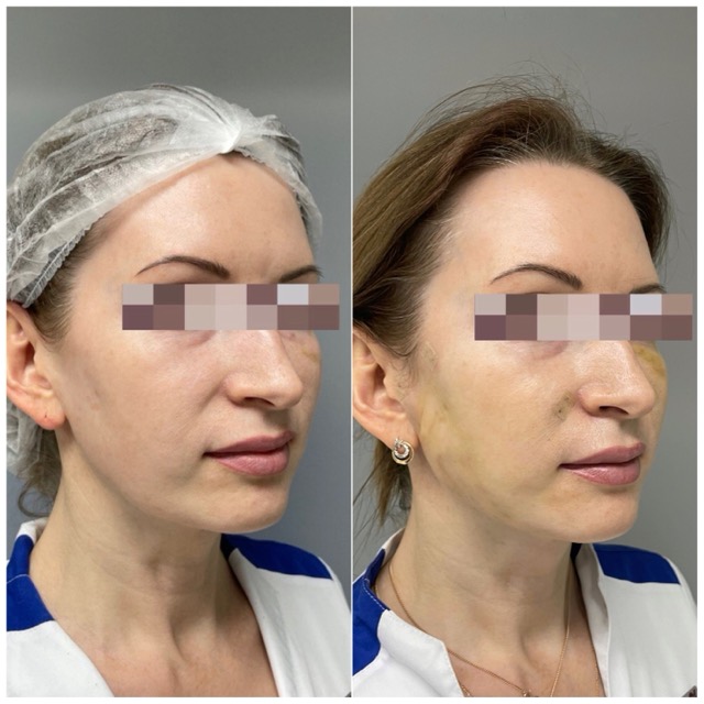 JK Clinic - до и после, процедура, Евгения Викторовна Проскурнина