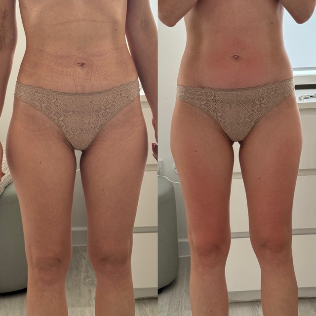JK Clinic - до и после, процедура, Марианна Валентиновна Шубина