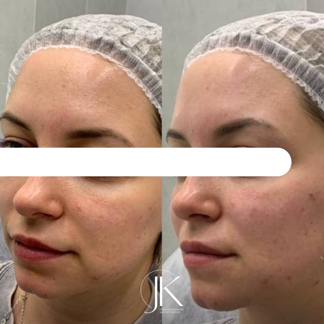 JK Clinic - до и после, процедура, Екатерина Викторовна Смирнова