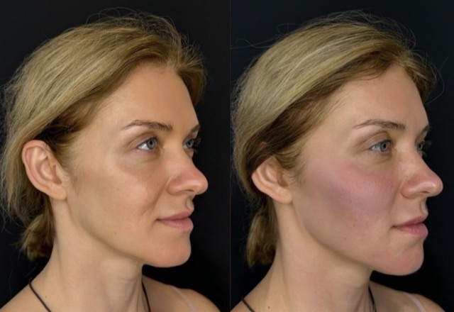 JK Clinic - до и после, СОЧЕТАННЫЕ МЕТОДИКИ, Мария Викторовна Титова