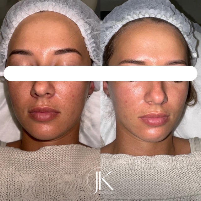 JK Clinic - до и после, Хелео, Анна Эдуардовна Вассарман