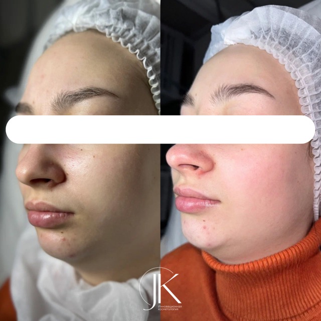 JK Clinic - до и после, Чистки пилинги, Анна Эдуардовна Вассарман