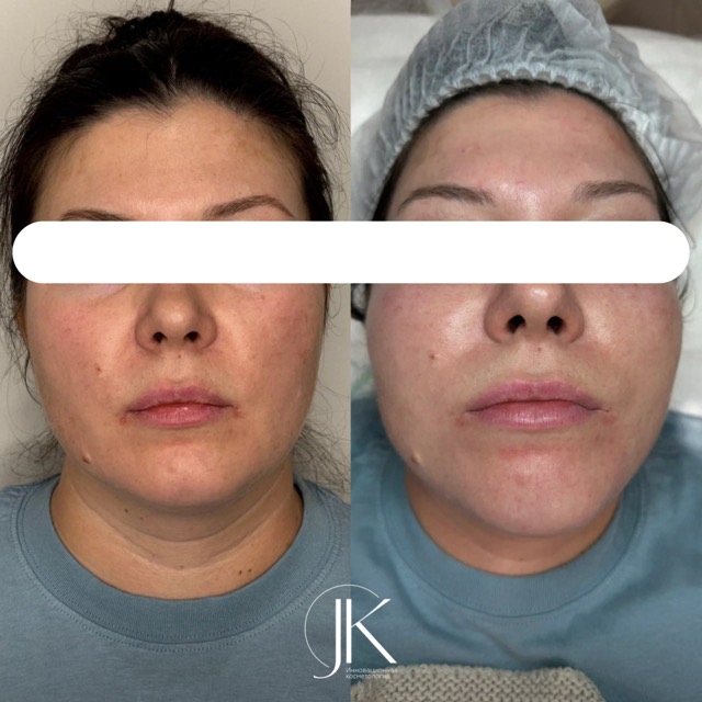 JK Clinic - до и после, процедура, Анна Эдуардовна Вассарман