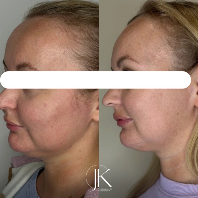 JK Clinic - до и после, РФ лифтинг, Анна Эдуардовна Вассарман